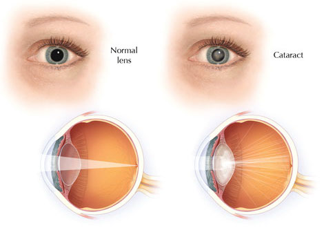 cataract vision night